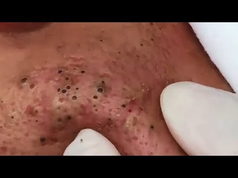چگونه به حذف جوش سر سیاه و چگونه به خلاص شدن از شر جوش سر سیاه جوش سر سیاه در صورت #56